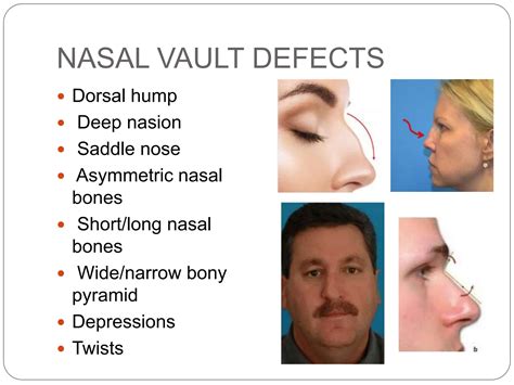 Nasal dorsum 2023.pptx