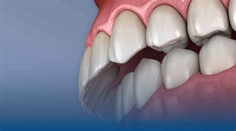 What is Overbite? Causes |Treatment solutions