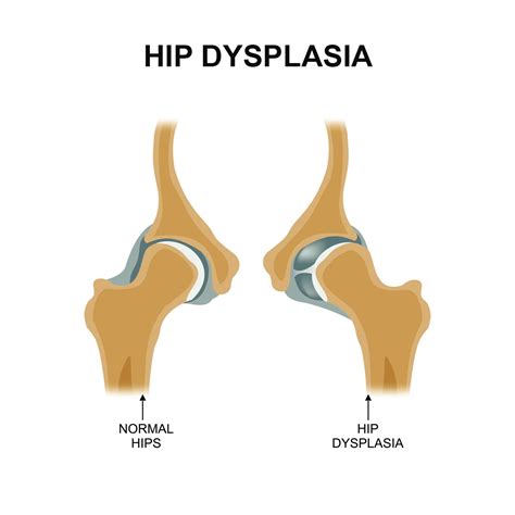 Hip Dysplasia Symptoms & Treatment| Aurora Health Care