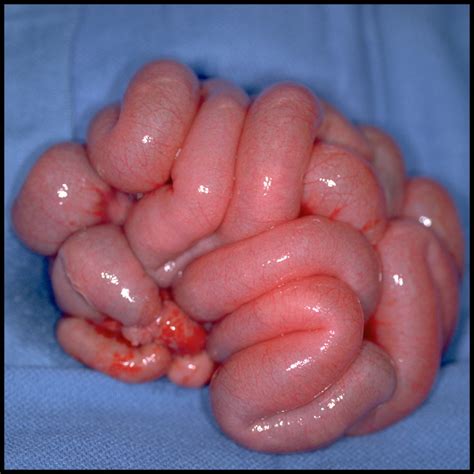Infant with non-bilious and bilious vomiting and a distended abdomen ...
