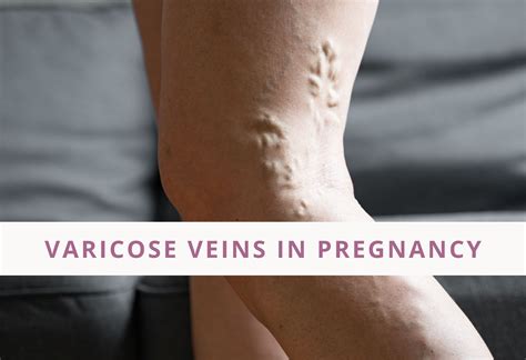 How to manage Varicose Veins In Pregnancy - Jenni Jenkins