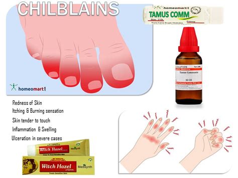 Top Chilblains Homeopathy Remedies, Swollen Fingers, Frostbite – Homeomart