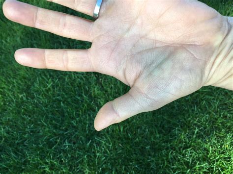 Burst Blood Vessel In Finger Images Blood Blisters: Causes, Diagnosis,