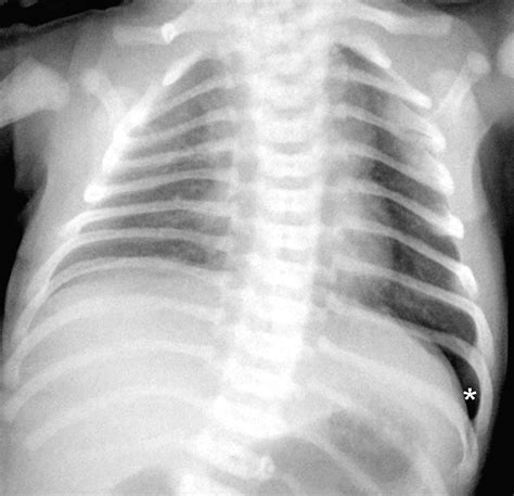 Sulcus Sign Explained 的图像结果