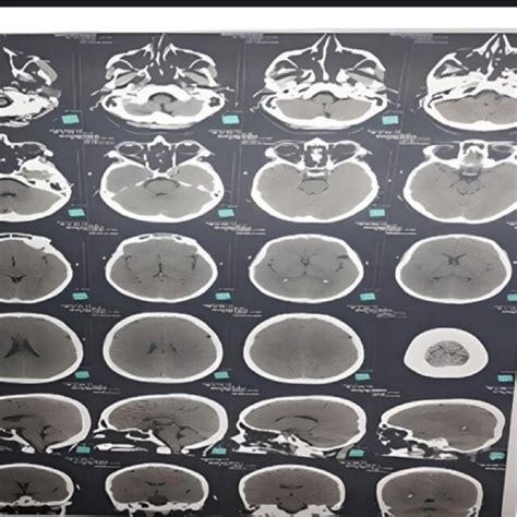 Image result for Normal Brain CT Scan