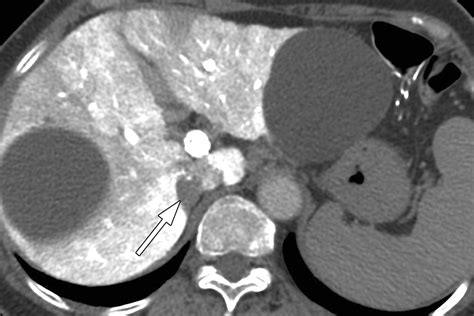 Adrenal Cortical Adenoma in Adrenohepatic Fusion Tissue: A Mimic of ...