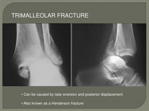 PPT - Ankle Fractures PowerPoint Presentation - ID:6596983