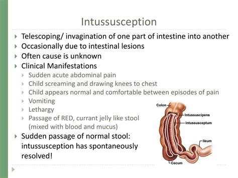 Image result for Intussusception Symptoms
