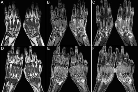 Magnetic Resonance Imaging of Bilateral Hands Is More Optimal Than MRI ...