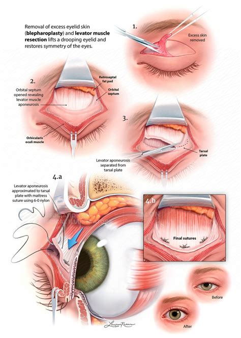 Image result for Levator Resection Surgery