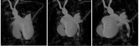 Image result for MRCP Biliary Tree