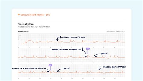 Sinus Rhythm Vs. Premature Atrial Contraction (Multiple) on Your Watch ...