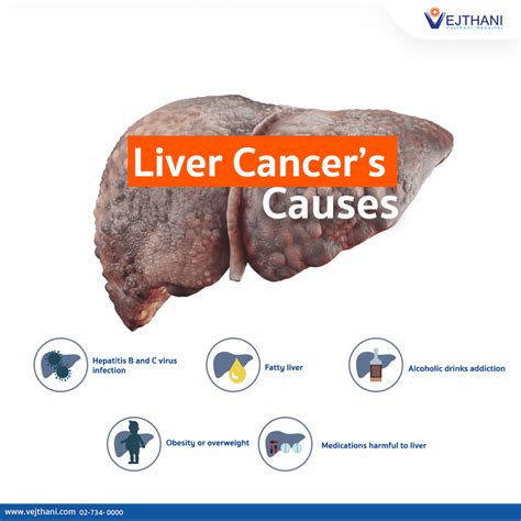 Liver Cancer’s Causes - Life Cancer Center