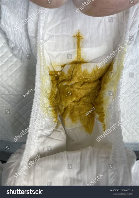 Baby Poop On Diaper Diarrhea Stock Photo 2260610125 | Shutterstock