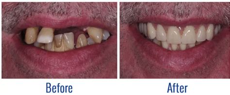 Image result for Immediate Denture Process