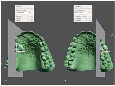 Non-Surgical Transversal Dentoalveolar Compensation with Completely ...