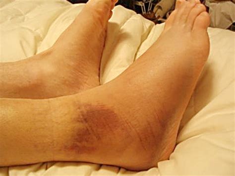 Broken Ankle - Symptoms, Recovery time, Pictures, Surgery, Treatment ...