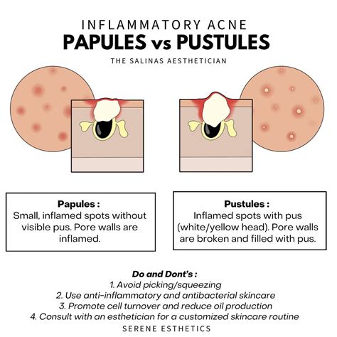 Nicole Gonzales | Serene Esthetics | Papules vs Pustules Let’s Break It Down! Both types of skin ...
