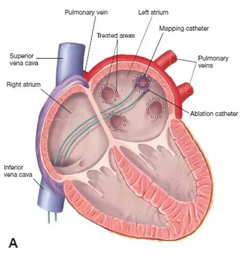 AFIB/Atrial Flutter Ablation | Heartplace | Cardiovascular Disease Specialists & Cardiac ...