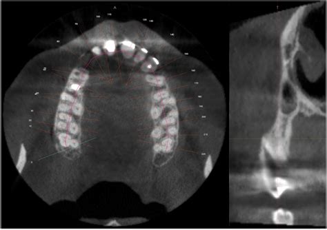 Sodium Hypochlorite Accident during Canal Treatment: Report of Four ...