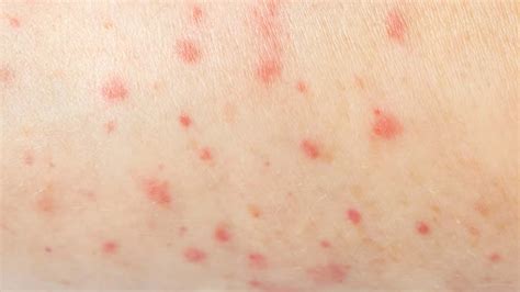 What Causes Red Spots on Skin? – NutritionFact.in