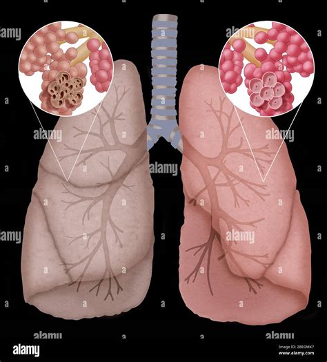 Image result for Emphysema Example