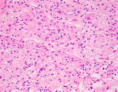 Pathology Outlines - Alveolar soft part sarcoma