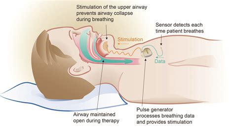 Inspire Device For Sleep Apnea Mri Safety at Blanca Wilkerson blog