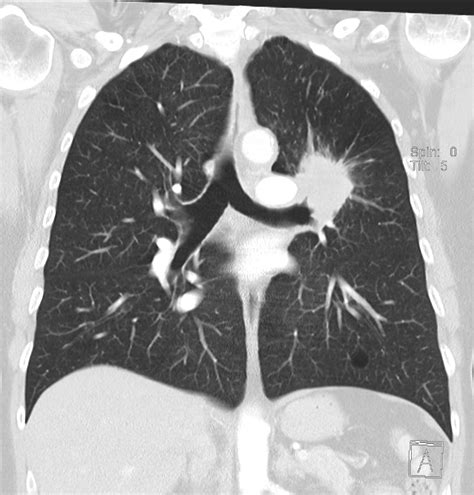 Lung Scarring On Ct Scan