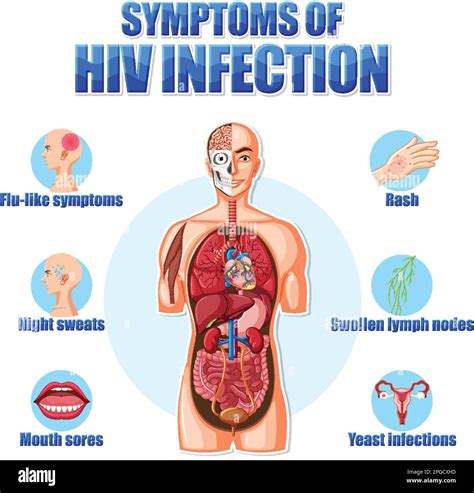 Informative poster of main symptoms of HIV illustration Stock Vector Image & Art - Alamy