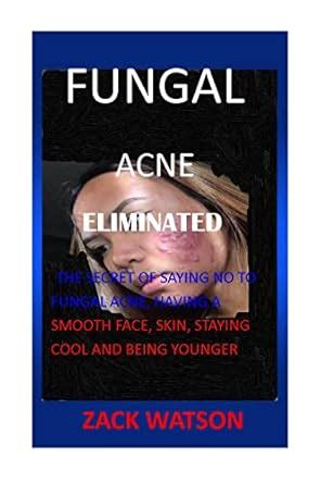 FUNGAL ACNE ELIMINATED: …THE SECRET OF SAYING NO TO FUNGAL ACNE, HAVING ...