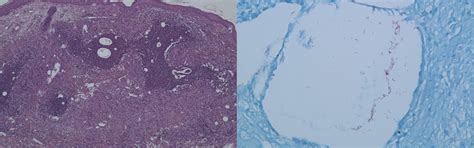Unverdächtige Anamnese, überraschende Diagnose - Dermatologie ...