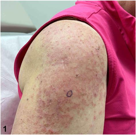 A photodistributed rash in a patient on apixaban - JAAD Case Reports