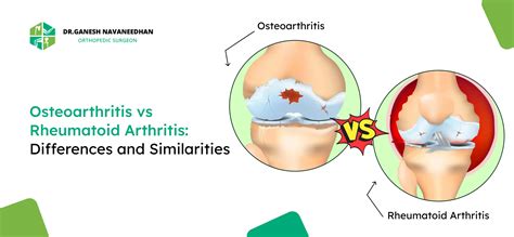 Difference Between Osteoarthritis and Rheumatoid Arthritis | Pictures of RA and OA