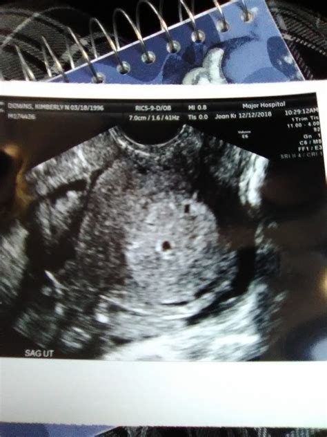 What Week Can You See Twins On An Ultrasound at Noah Weber blog