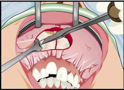 Article on SARPE published in the Journal of Oral and Maxillofacial Surgery - Instituto Maxilofacial