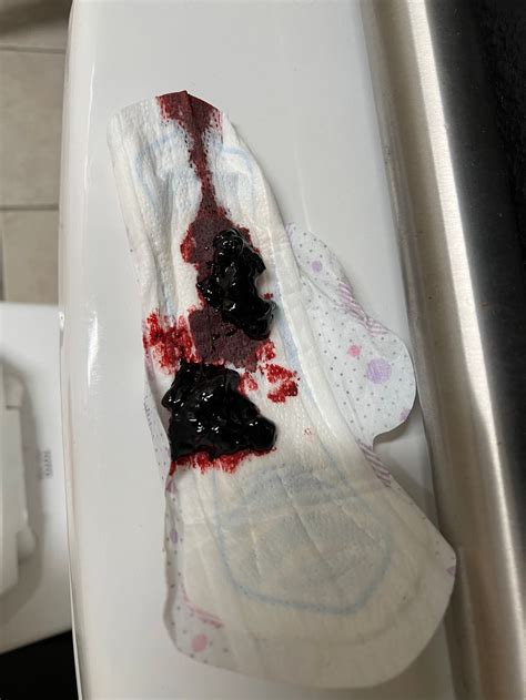 Blood Clots After Miscarriage