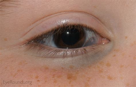 Atlas Entry - Oculodermal melanocytosis (nevus of Ota)