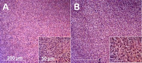 Tumor histology. A) Histology of the original patient sarcoma. B)... | Download Scientific Diagram