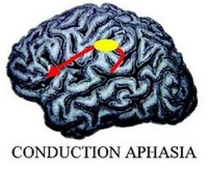 Image result for Examples of Conduction Aphasia