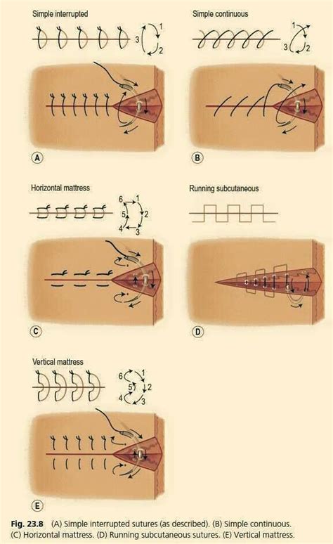 Image result for Continuous Suture Patterns