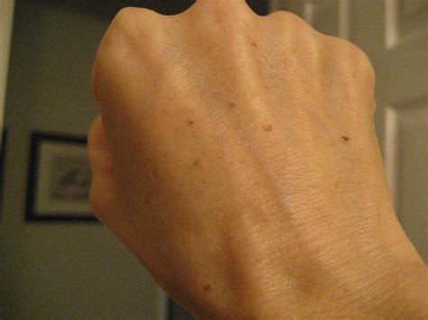 Chemical Peels for Acne and Anti Aging: Hand Age Spots Treated with TCA Peel: Days 1-10