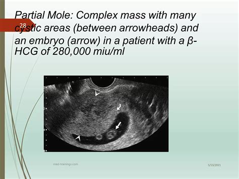 Molar Pregnancy | PPT