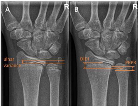 Indications and Timing of Guided Growth Techniques for Pediatric Upper Extremity Deformities: A ...