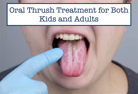 Oral Candidiasis Treatment Best Mouth Fungal Infection, Stomatitis,