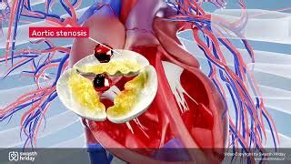Aortic Stenosis Explained | Aortic Stenosis Animation