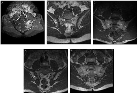 Sacroiliac Joint Xray