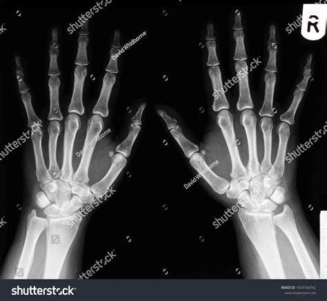 Normal Left Hand X Ray