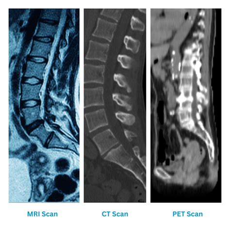 Spinal Tumors: Symptoms And Treatment Options — MacKay Spine and Brain