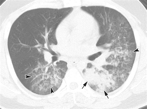 Chest X Ray Vs Ct Scan Pneumonia at Frederick Rosado blog